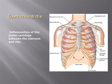 Costochondritis