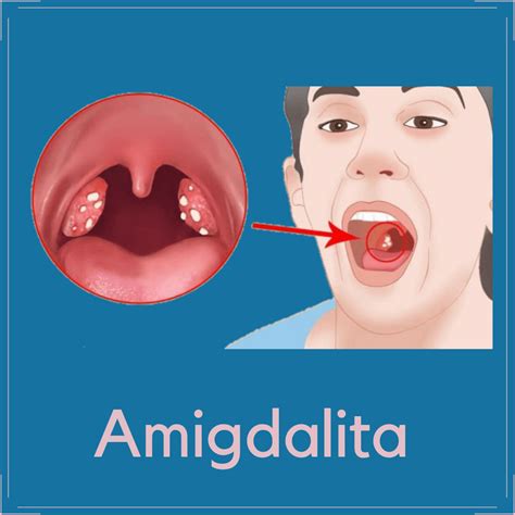 Angina Amigdalita E Medicinamd