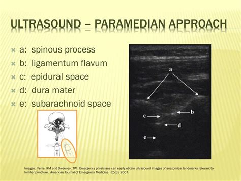 Ppt Ultrasound Guided Lumbar Puncture Powerpoint Presentation Free