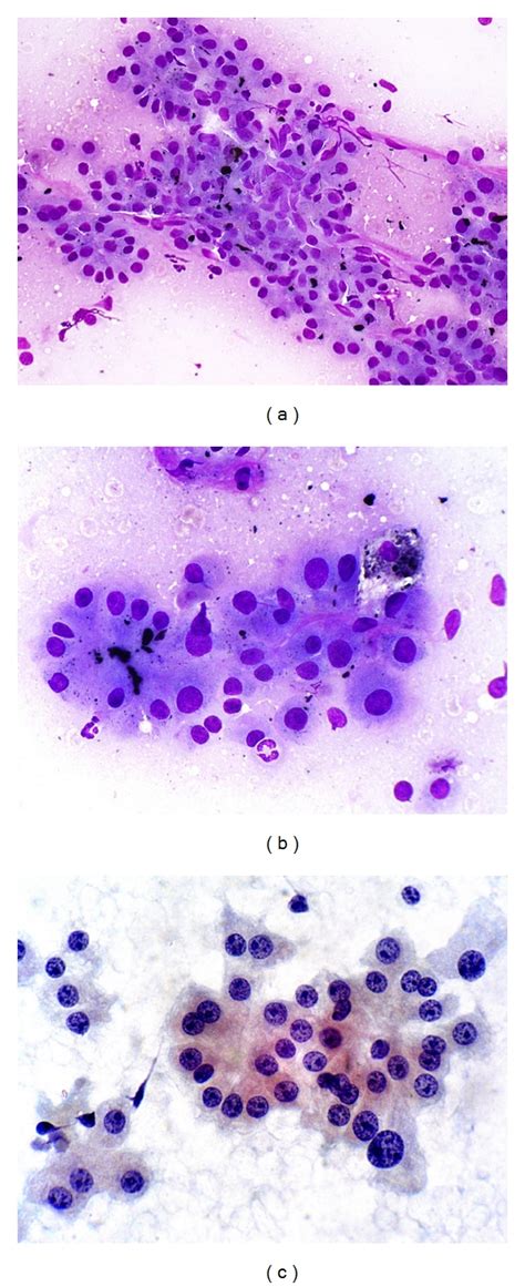 Fna Of Well Differentiated Hepatocellular Carcinoma A Malignant