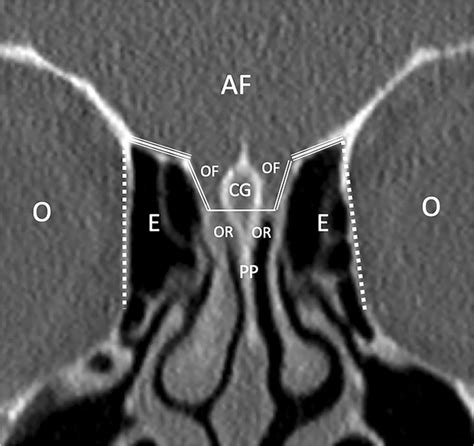 Ethmoid Sinus Anatomy Coronal Ct Image In Bone Algorithm From An