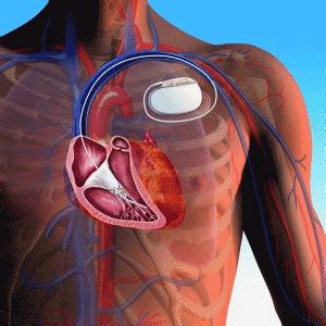 Der defibrillator ist ein wichtiger bestandteil der wiederbelebung und hat bereits zahllose leben gerettet. Behandlungen - CRO Medical