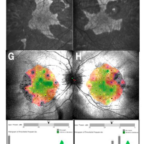 Retinal Imaging In Two Female Choroideremia Carriers Phenotype Of An