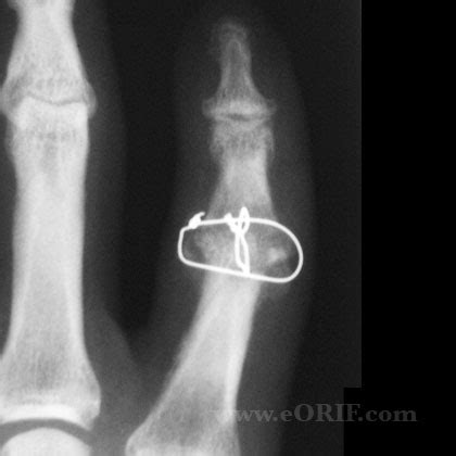 PIP Arthritis M19.049 715.14 | eORIF