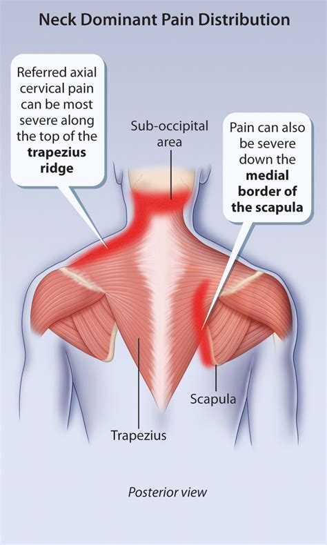 A Pain in the Neck | healthPlexus.net