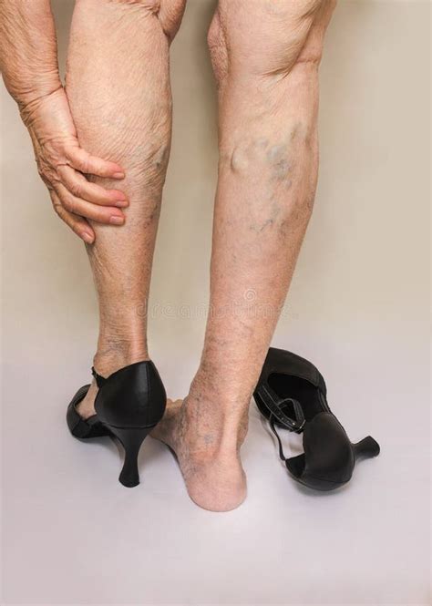 Spider Varicose Veins Free Stock Photos Stockfreeimages