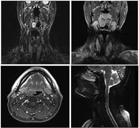 Neck Magnetic Resonance Imaging Of The Preoperative Tumor Top Left And