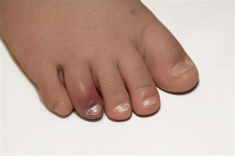 Bruised Toe Photograph By Science Stock Photography