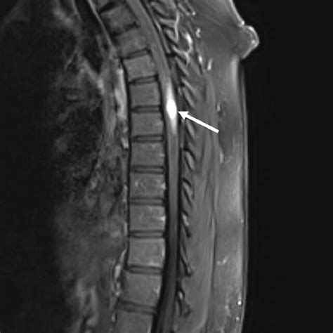 Sagittal Mri T1 Sequence With Gadolinium Contrast Demonstrating Avidly