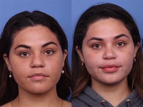 Rhinoplasty Before And After Pictures Case 341 Scottsdale And Phoenix Az Hobgood Facial
