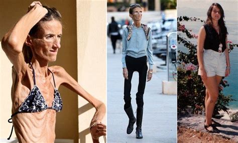 20 zdjęć pokazujących skutki anoreksji