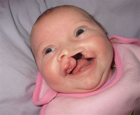 Apr 23, 2018 · the lips are the most affected area of the face when it comes to windburn. Understanding Cleft Lips and Palates and Your Treatment ...