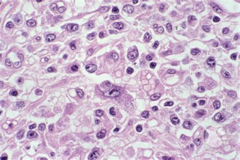 Anaplastic Large Cell Lymphoma 8