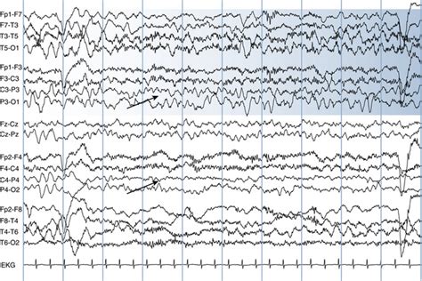 The Abnormal Eeg Neupsy Key