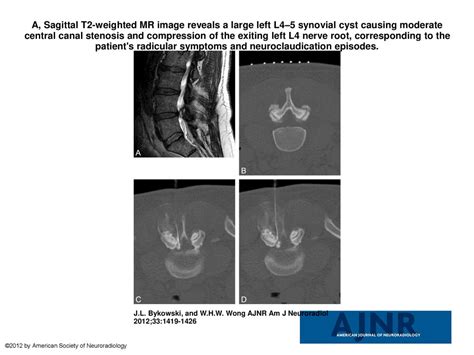 A Sagittal T2 Weighted Mr Image Reveals A Large Left L45 Synovial