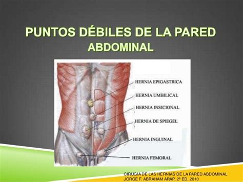 Anatomia Y Hernias De Pared Abdominal Umbilical Hernia Abdominal