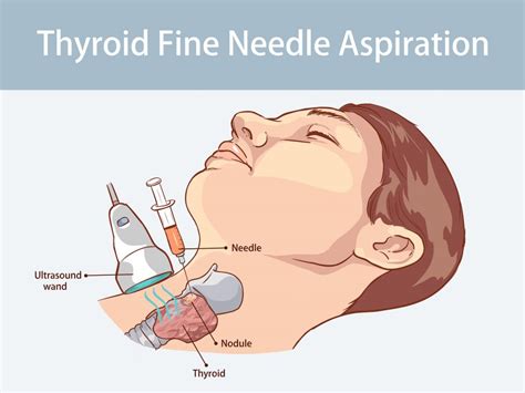 Is Ultrasound Guided Fine Needle Aspiration Fna Of The Parathyroid