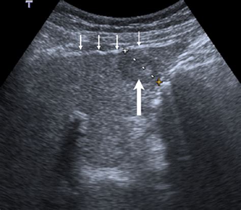 Non Invasive Evaluation Of Liver Cirrhosis Using Ultrasound Clinical