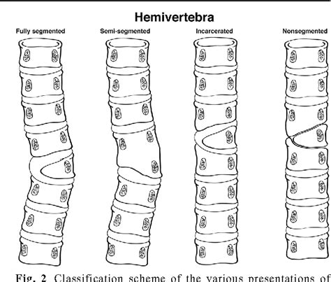 Hemivertebra Nenormalnost Hrbtenice Povezava S Skoliozo