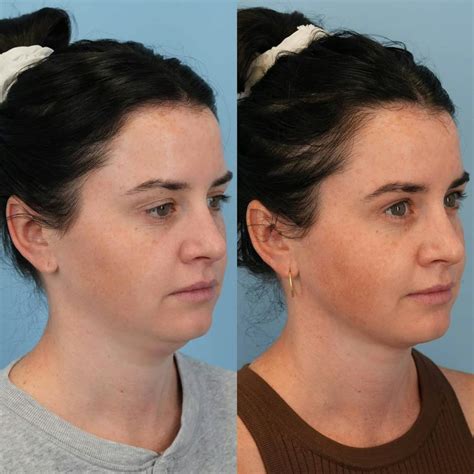 Patient 264728 Facetite And Thermitight Before And After Photos Bloom