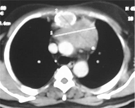 Contrast Enhanced Computed Tomography Cect Chest Axial Section