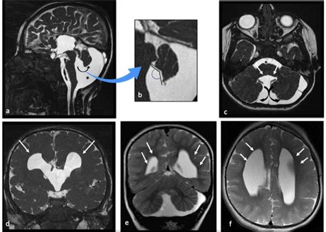 Mri Of A 3 Year Old Boy With Dandy Walker Variant A C And Associated