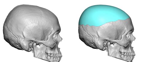 Custom Skull Implant Design For Parasagittal Skull Deformity Side View