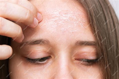 Premium Photo Female Forehead With Peeling Skin Allergies Eczema
