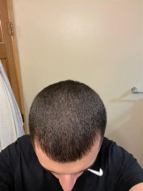 Mature or receding hairline? : r/malehairadvice