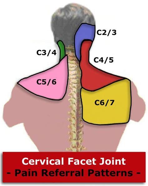 Cervical Facet Pain Referral Pattern Cervical Facet Syndrome