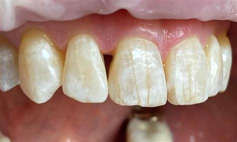 Bioclear To Close Gum Line Black Triangles Of Space Before And After