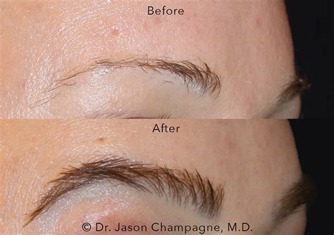 Eyebrow Hair Transplantation Gallery Beverly Hills Plastic Surgeon Dr Jason Champagne