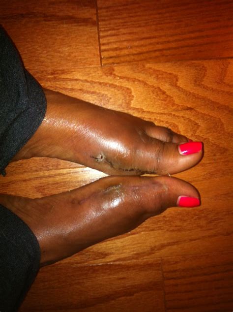 Swelling can linger for some time after abdominoplasty as it's one of the more invasive plastic surgery procedures. Before and after Bunion surgery