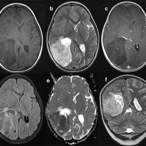 Preoperative Magnetic Resonance Imaging Mri Axial Precontrast