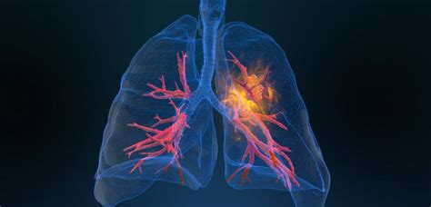 Lung Cancer Disparities Are Seen In Widespread Resources Highlighted In