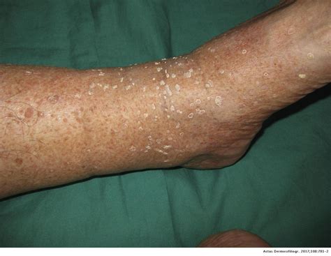 Hyperkeratotic Lesions On Legs Actas Dermo Sifiliográficas