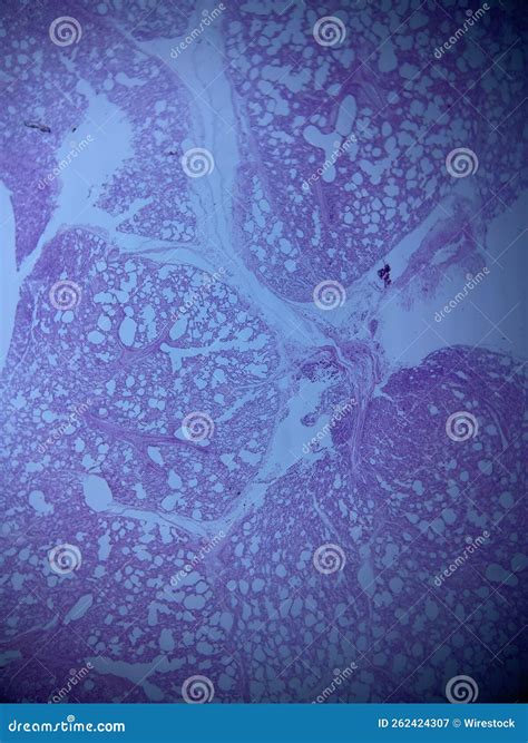 Lung Tissue Histology Isolated Stock Image Image Of Core Pneumonia