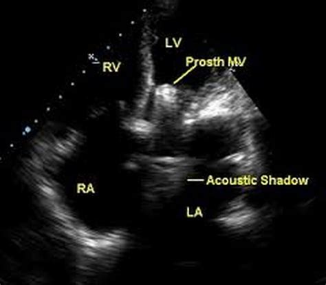 Prosthetic Mitral Valve Echocardiogram Images And Photos Finder