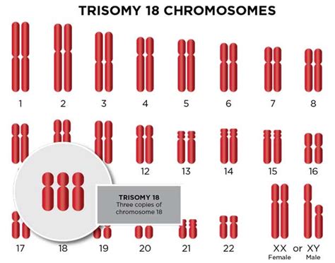 Trisomy 18 Edwards Syndrome Types And Diagnosis Ssm Health