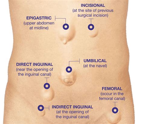 Hernia Inguinal Hernia Size Classification Png Image Transparent My
