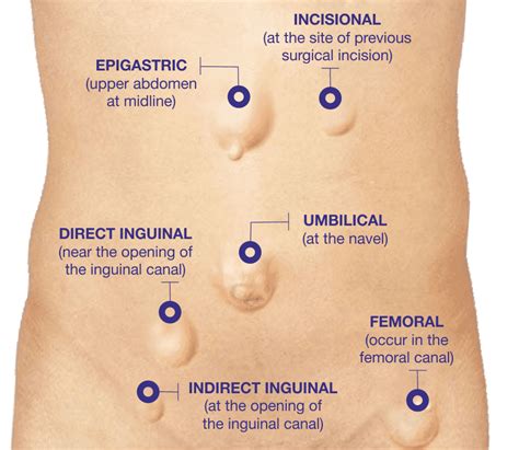 Stomach hernia or hiatal hernia, is where the lower esophageal sphincter, which controls passage of food between the stomach and esophagus. Best Hospital for Hernia Treatment: Pace Hospitals