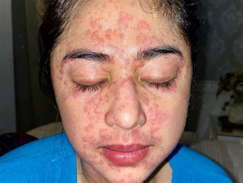 Dewi Perssiks Face Is Full Of Redness Recognizes The Signs Of Skin