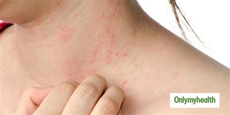 बच्‍चों में एलर्जी होने के हैं 8 प्रमुख कारण एक्‍सपर्ट से जानें एलर्जी