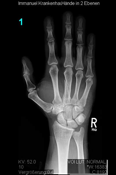 Im handgelenk ist auf der ellenseite ein band, der sogenannte tfcc oder discus, eine dem meniskus im knie vergleichbare struktur, die aber zusätzlich noch eine wichtige stabilisierende funktion für das. Knochenbrüche an Hand und Fingern | Obere Extremität, Hand ...