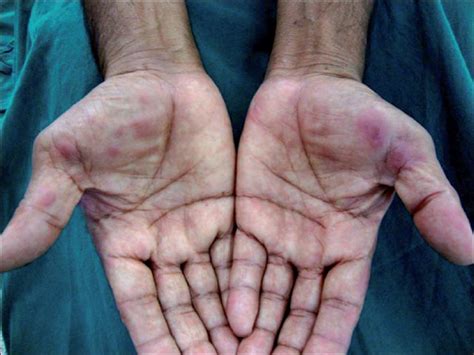 Red palm hand clip art. Erythema elevatum diutinum associated with scleritis ...