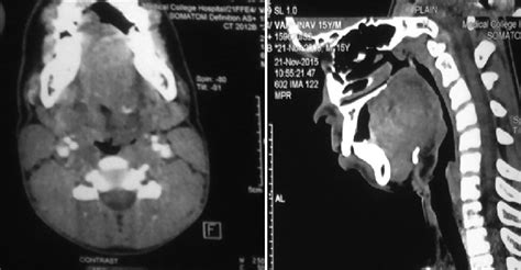 Postcontrast Computed Tomography Showing Large Lobulated Soft Tissue