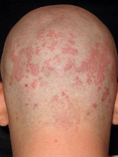 Red Rashes On Scalp Pictures Photos