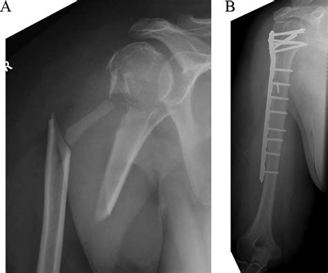 A Complex Metadiaphyseal Proximal Humeral Fracture In Geriatric Host