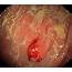 Carcinoid Tumour Photograph By Gastrolab/science Photo Library