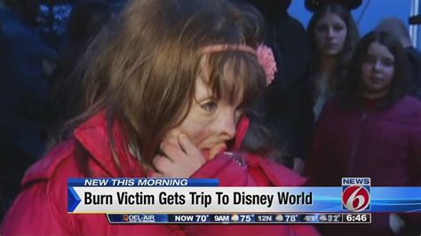 Burn Victim Gets Trip To Disney World Youtube